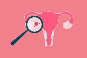 5 fatos pouco conhecidos sobre a endometriose